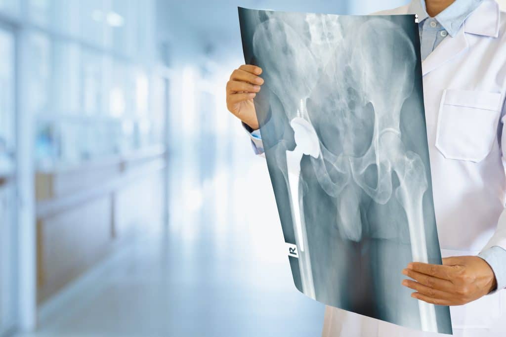 cleveland hip replacement lawyer