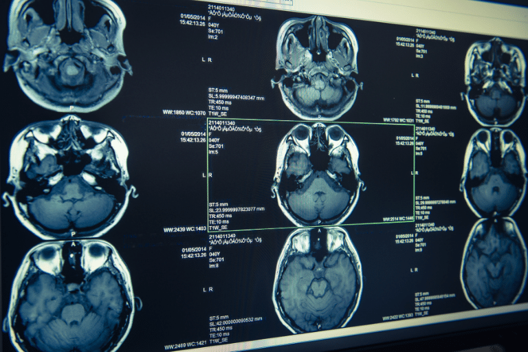 How Traumatic Brain Injuries Can Change Behavior and Personality