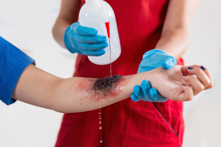 The Long-Term Effects of Chemical Burn Injuries